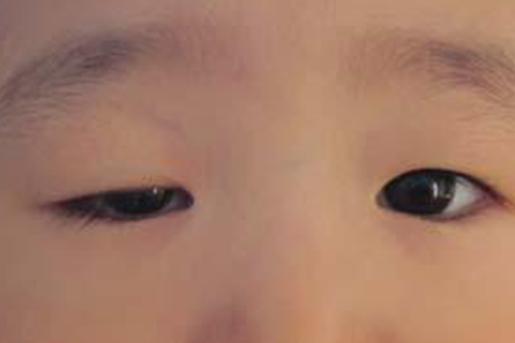 上睑下垂黑眼珠不对称图 上睑下垂黑眼珠不对称图