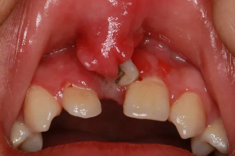 结节病上唇系带肉芽增生图