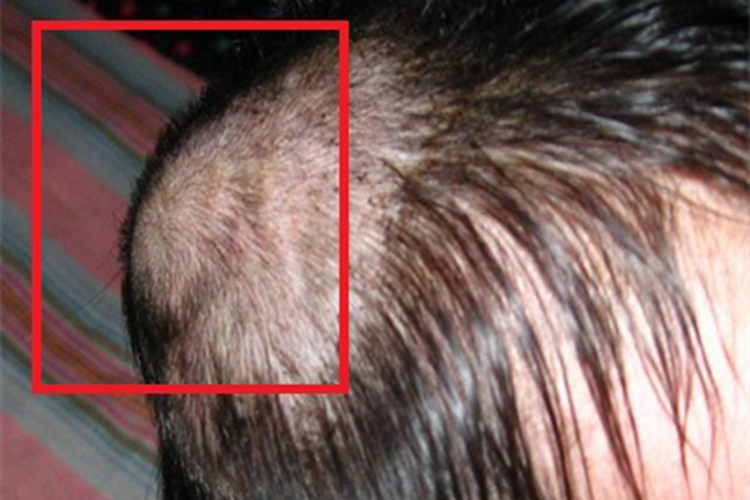 头皮血肿头部肿块图 头皮血肿头部肿块图