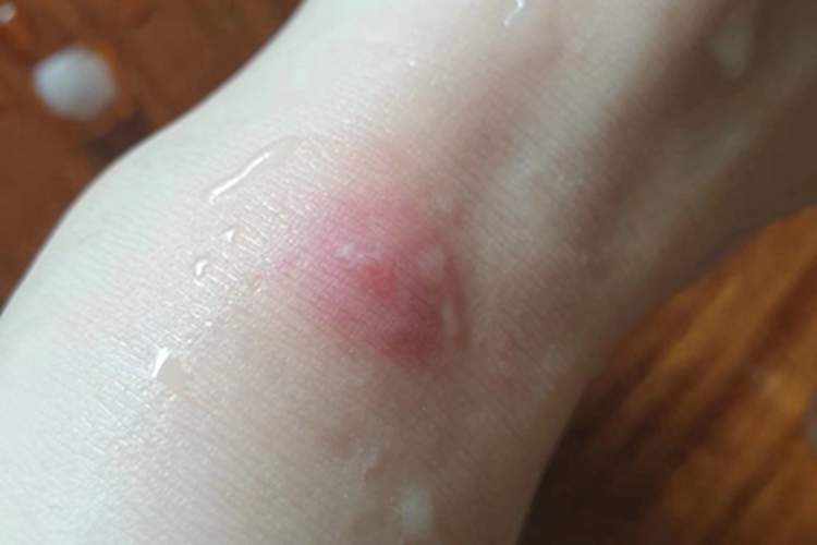 蜈蚣蜇伤症状图 蜈蚣蜇伤症状图