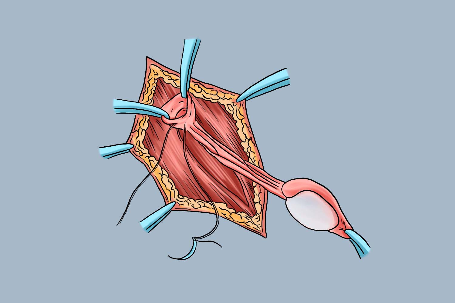 睾丸固定术图解_有来医生