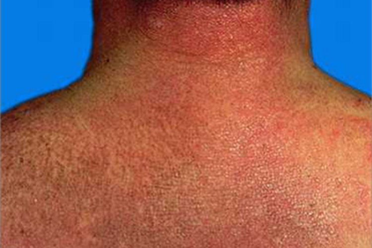 皮肌炎背部症状图