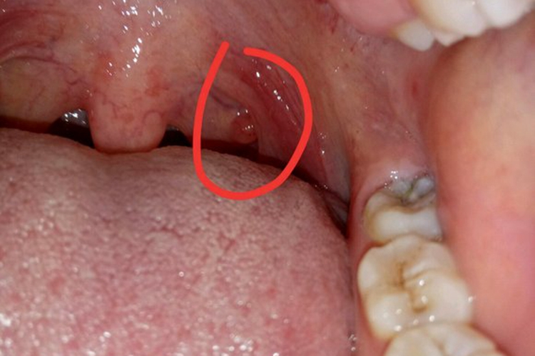 喉咙里长疣体图