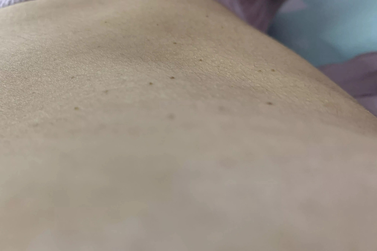 胸下面脂溢性角化病图