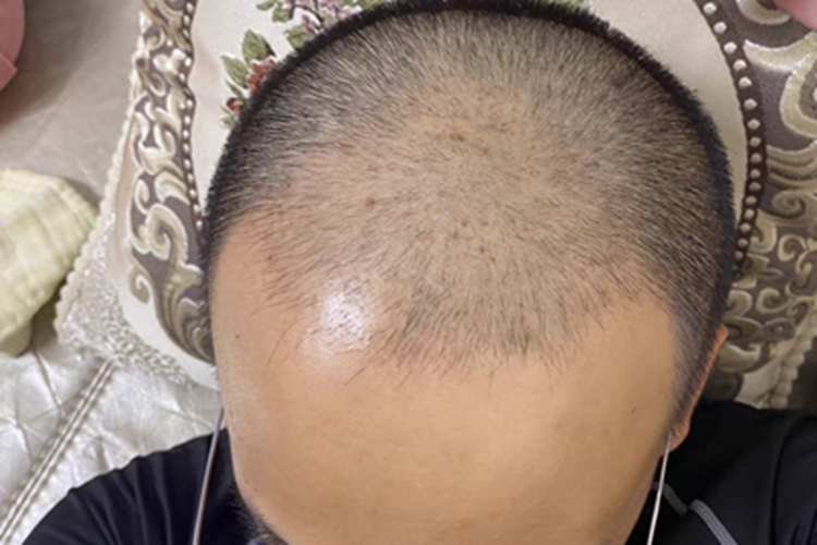 雄激素性脱发头部头发减少图