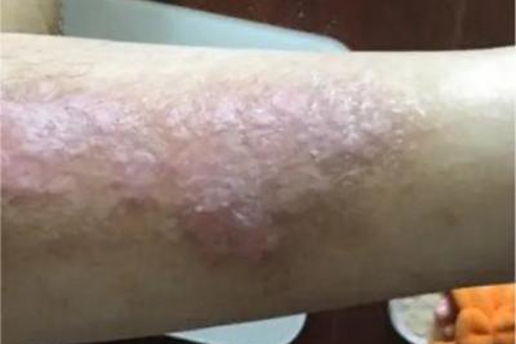 慢性湿疹胳膊发红增厚图 慢性湿疹胳膊发红增厚图