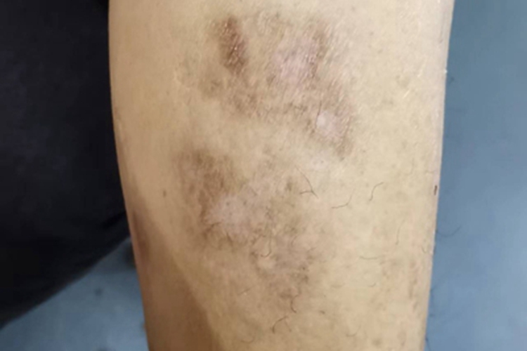 穿通性毛囊炎瘢痕图