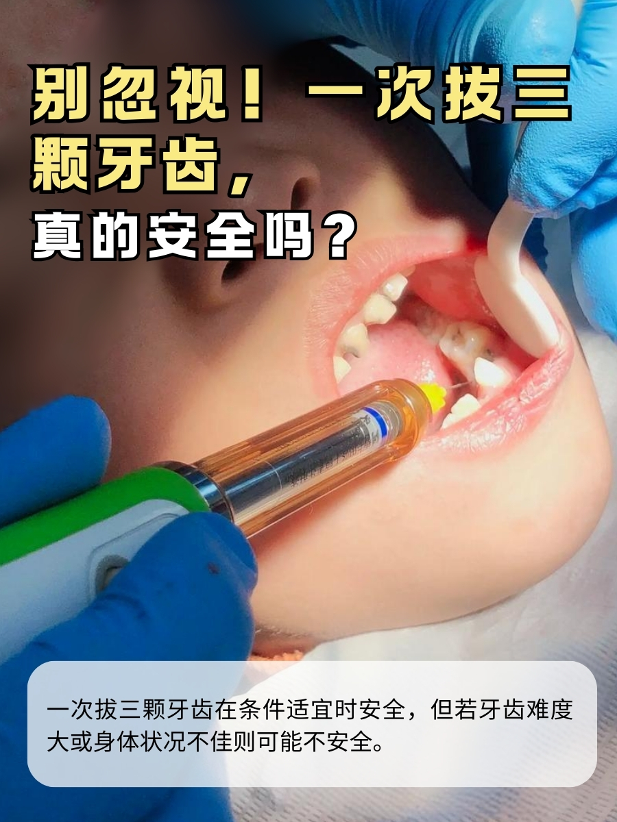 别忽视！一次拔三颗牙齿，真的安全吗？