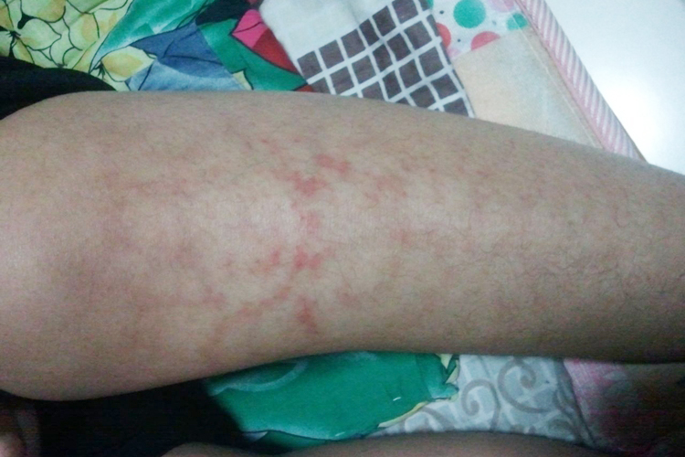 毛细血管扩张症图 毛细血管扩张症图