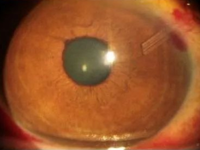 新生血管性青光眼房角关闭期眼球红斑图.jpg