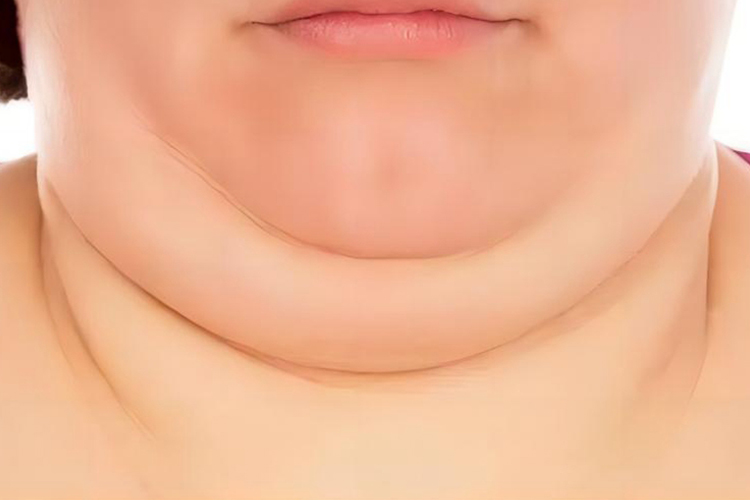 脖子肥胖图