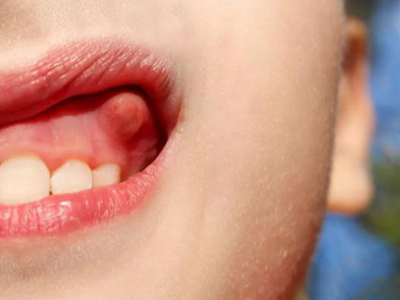 口腔癌可在牙龈上出现红色肿块,呈球形,肿块质地较硬,表面无破溃,患者