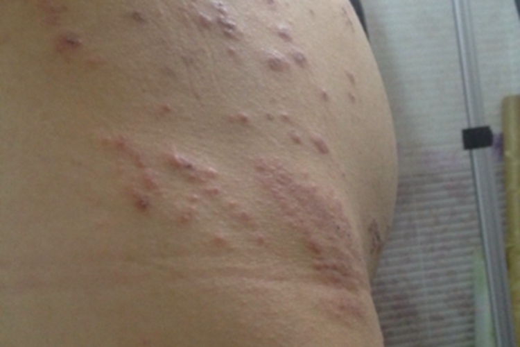 妊娠多形疹疙瘩图 妊娠多形疹疙瘩图