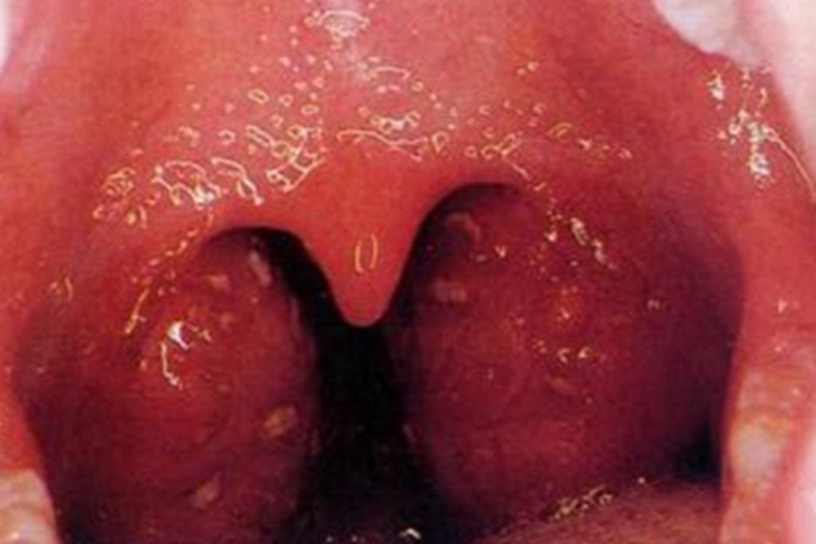 化脓性扁桃体炎扁桃体白点图 化脓性扁桃体炎扁桃体白点图