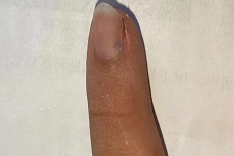 血管球瘤指甲症状图 血管球瘤指甲症状图