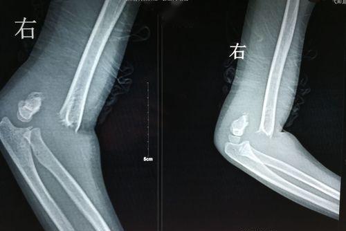 有移位型伸直型肱骨髁上骨折图