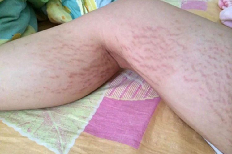 萎缩纹腿上都是红色条纹图