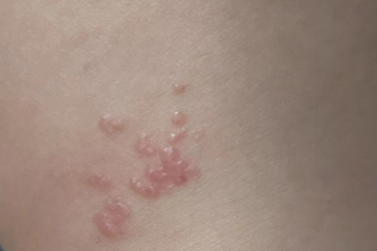 海绵状淋巴管瘤侧颈小水疱图