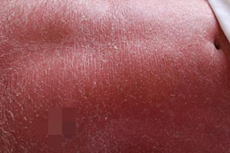 红皮病型银屑病腹部脱屑图 红皮病型银屑病腹部脱屑图