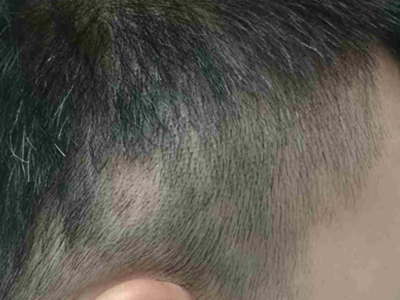 梅毒性脱发头上秃了一小块图.jpg