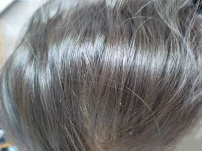 毛发管型头发上有白色管状物附着图.jpg
