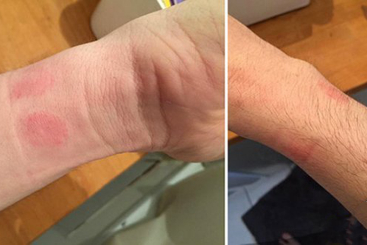 镍过敏皮肤红斑图