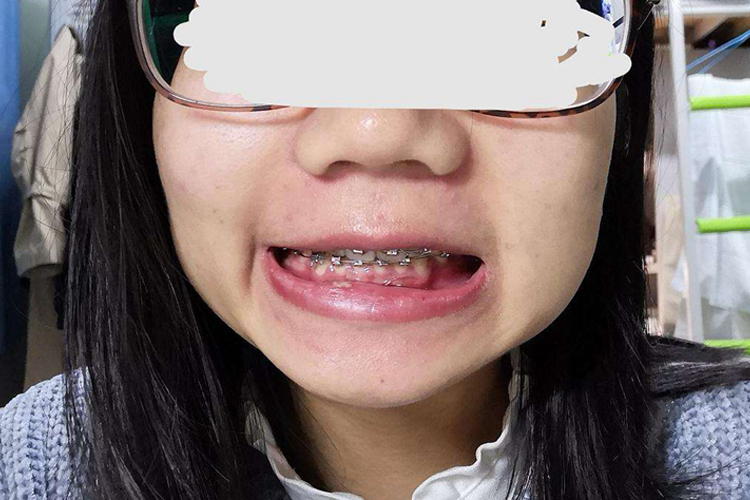 正畸内收过度图