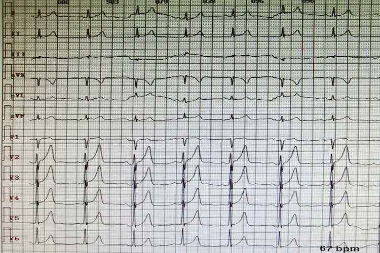 心电图早期复极图