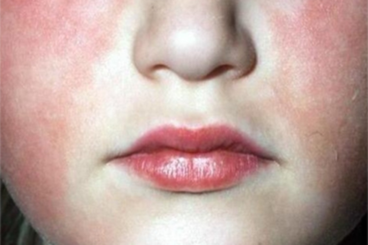 普通型猩红热口周苍白圈图