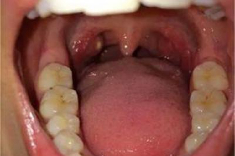 淋菌性咽炎扁桃体化脓图