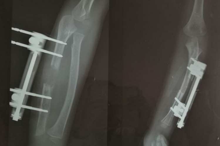 骨延长纤维骨痂生长图