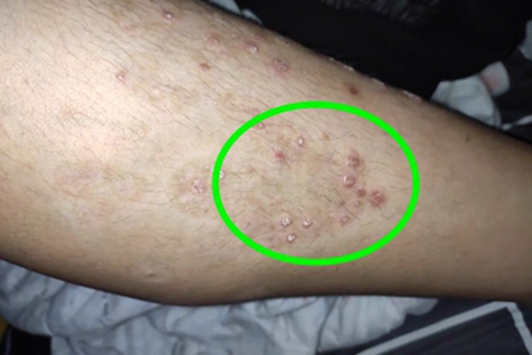 慢性湿疹水疱图 慢性湿疹水疱图