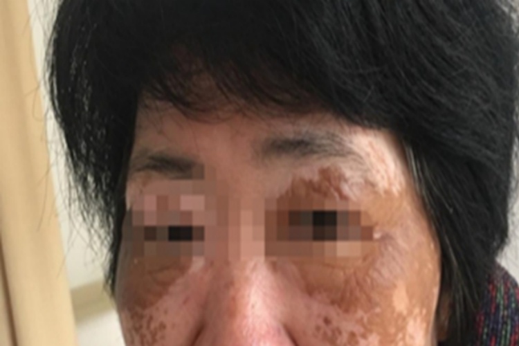 色素性化妆品皮炎眼周出现褐斑图