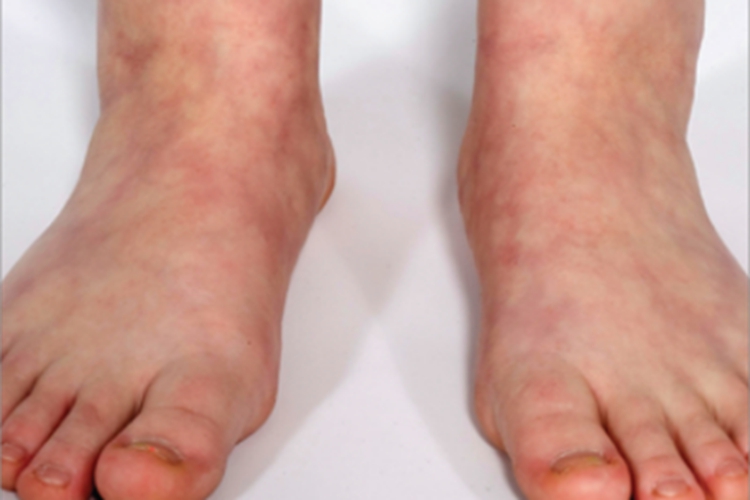 皮肤型结节性多动脉炎有斑图 皮肤型结节性多动脉炎有斑图