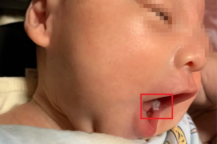 婴儿鹅口疮后槽牙位置发白图