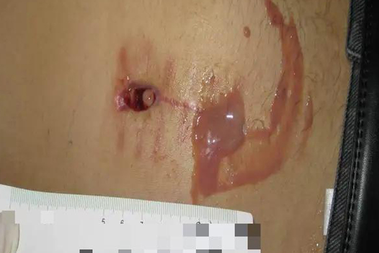 阑尾炎微创手术伤口感染图