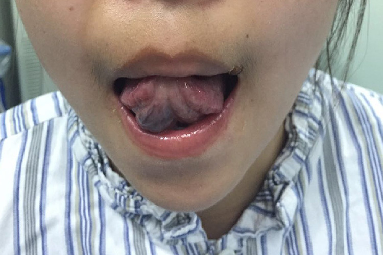 舌部海绵状血管瘤图