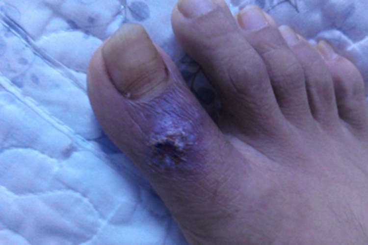 脚趾长水疱破了结黑痂图 脚趾长水疱破了结黑痂图