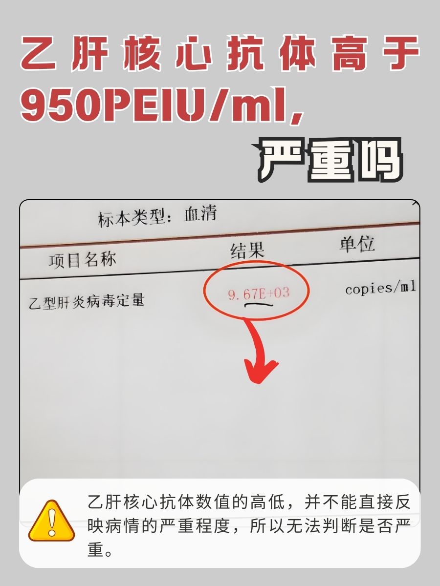 乙肝核心抗体高于950PEIU/ml，严重吗？