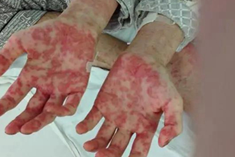 白血病手掌症状图