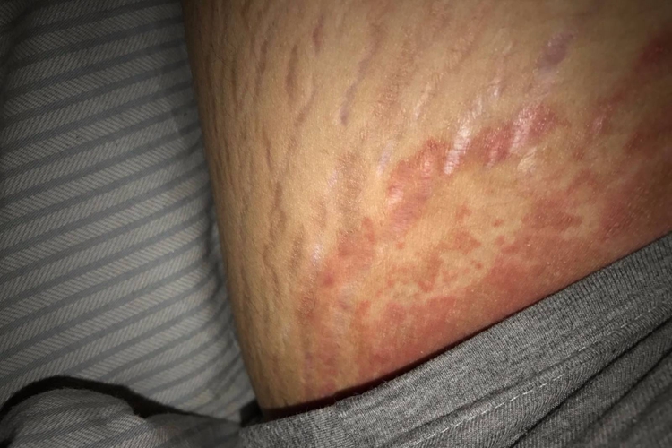 大腿根部有红色条纹图 大腿根部有红色条纹图