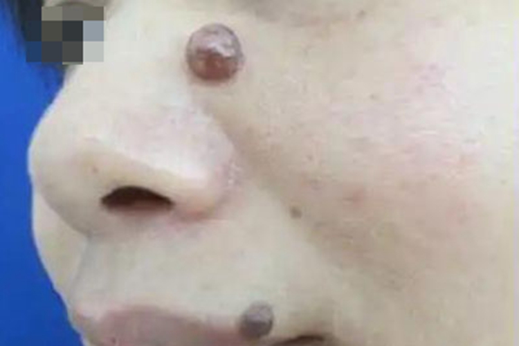 毛母质瘤皮肤结节图