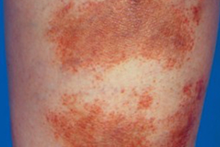 色素苔藓性紫癜样皮炎小腿红斑图 色素苔藓性紫癜样皮炎小腿红斑图