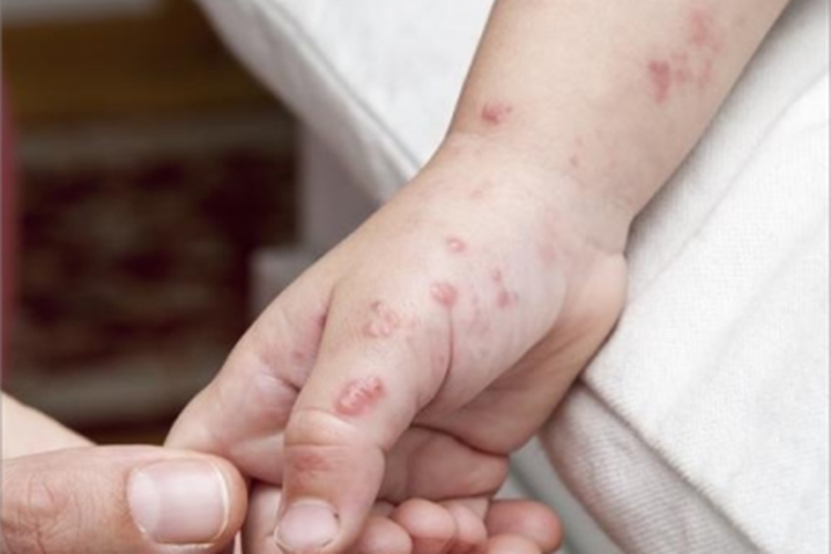 男性三期梅毒手部症状图 男性三期梅毒手部症状图