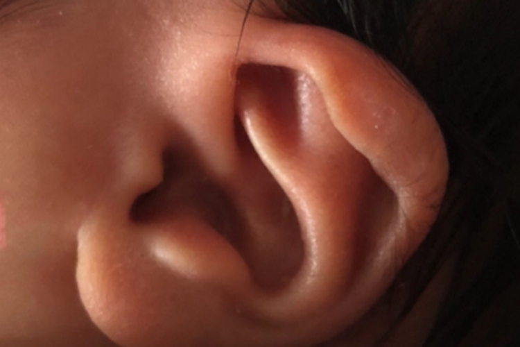 轻度杯状耳耳廓症状图 轻度杯状耳耳廓症状图