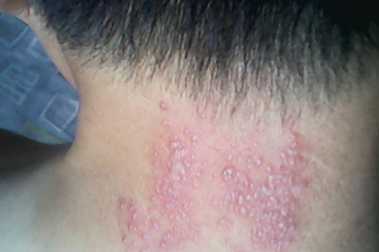 螨虫皮炎后颈症状图