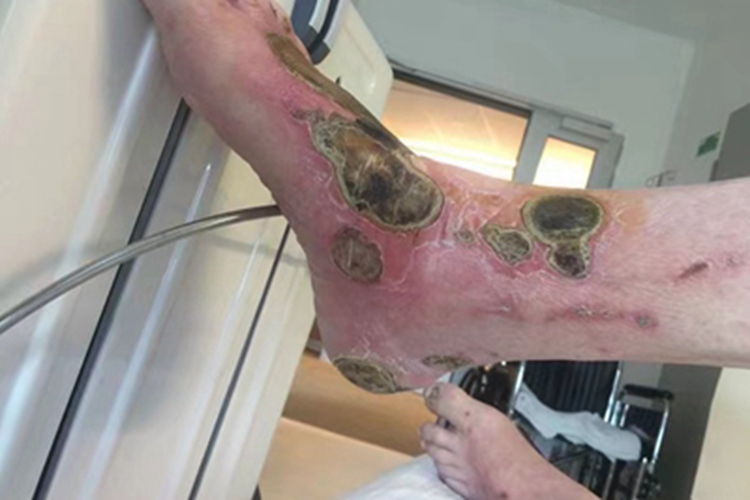 坏疽性蜂窝织炎脚部症状图