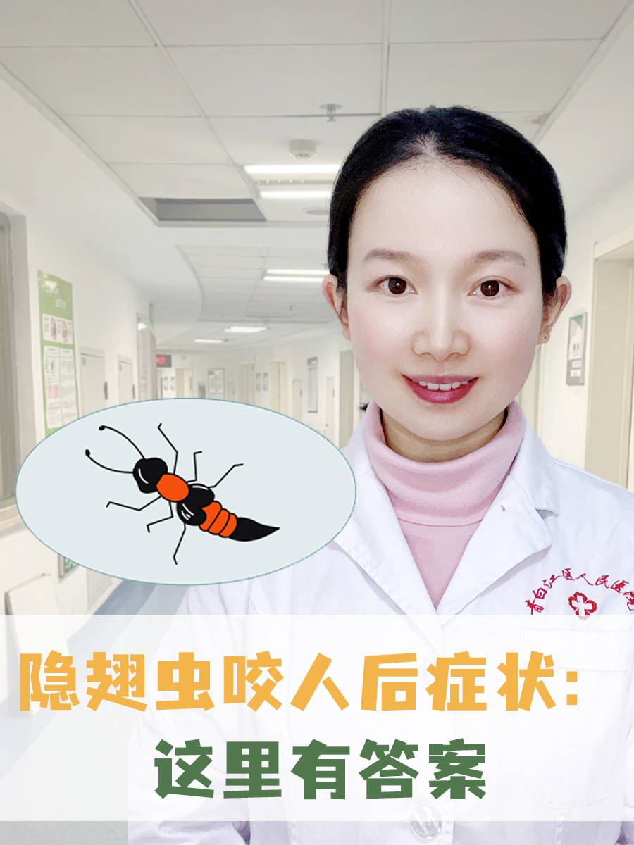 隐翅虫咬人后症状：这里有答案