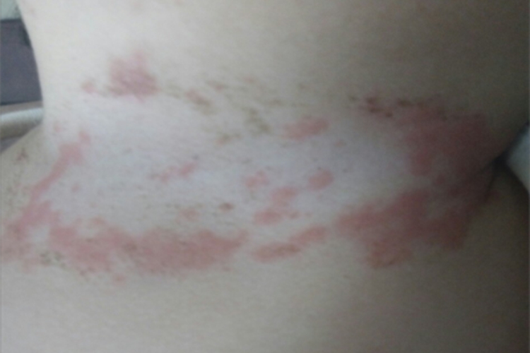湿疹型药疹颈部红斑图