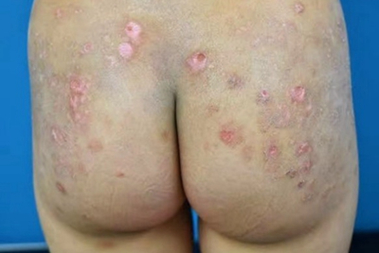 自体敏感性湿疹臀部坑图